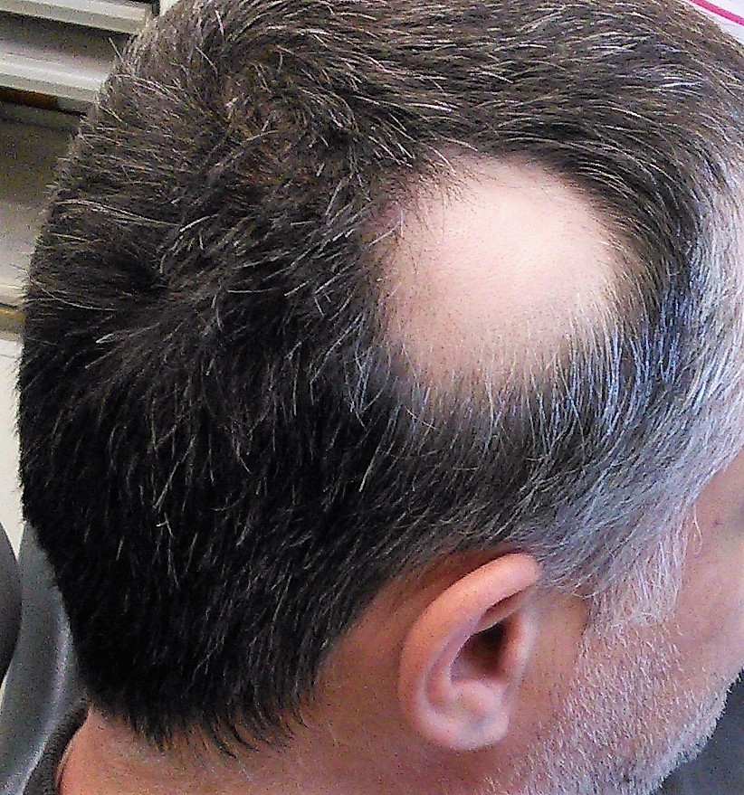 Imágen de Alopecia Areata