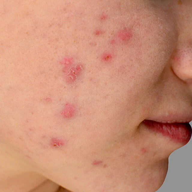 Acne Image