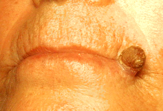 Imagen de Queratosis Actínica 