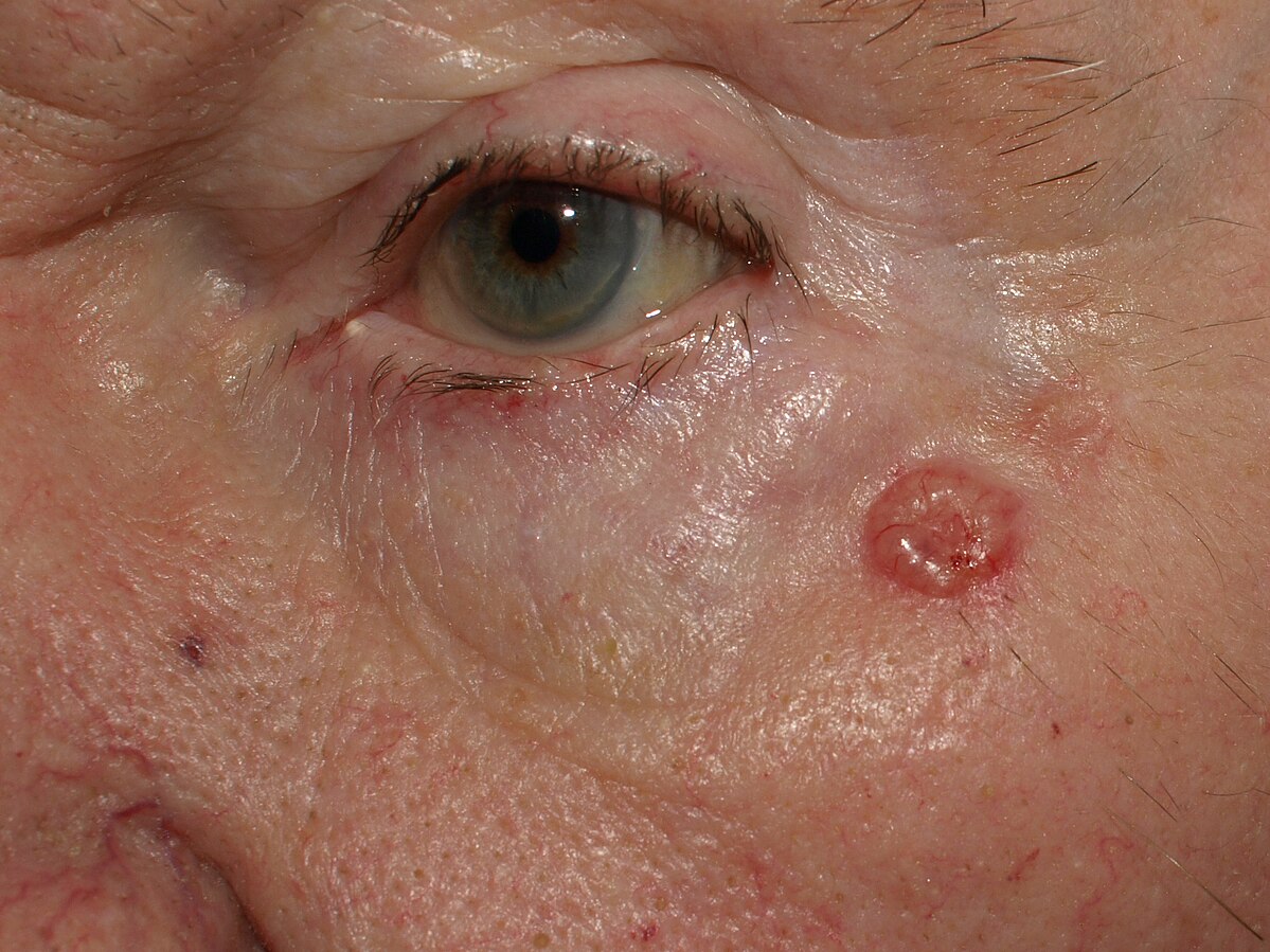 Imágen de Carcinoma Basocelular