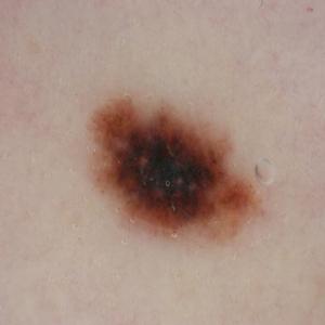 Melanoma Image