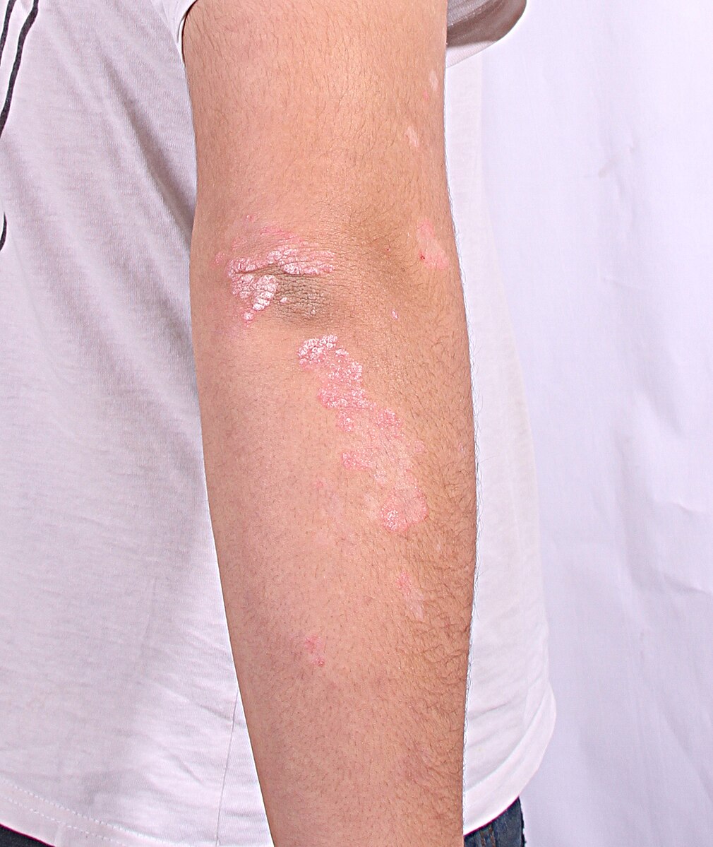 Imagen de Psoriasis